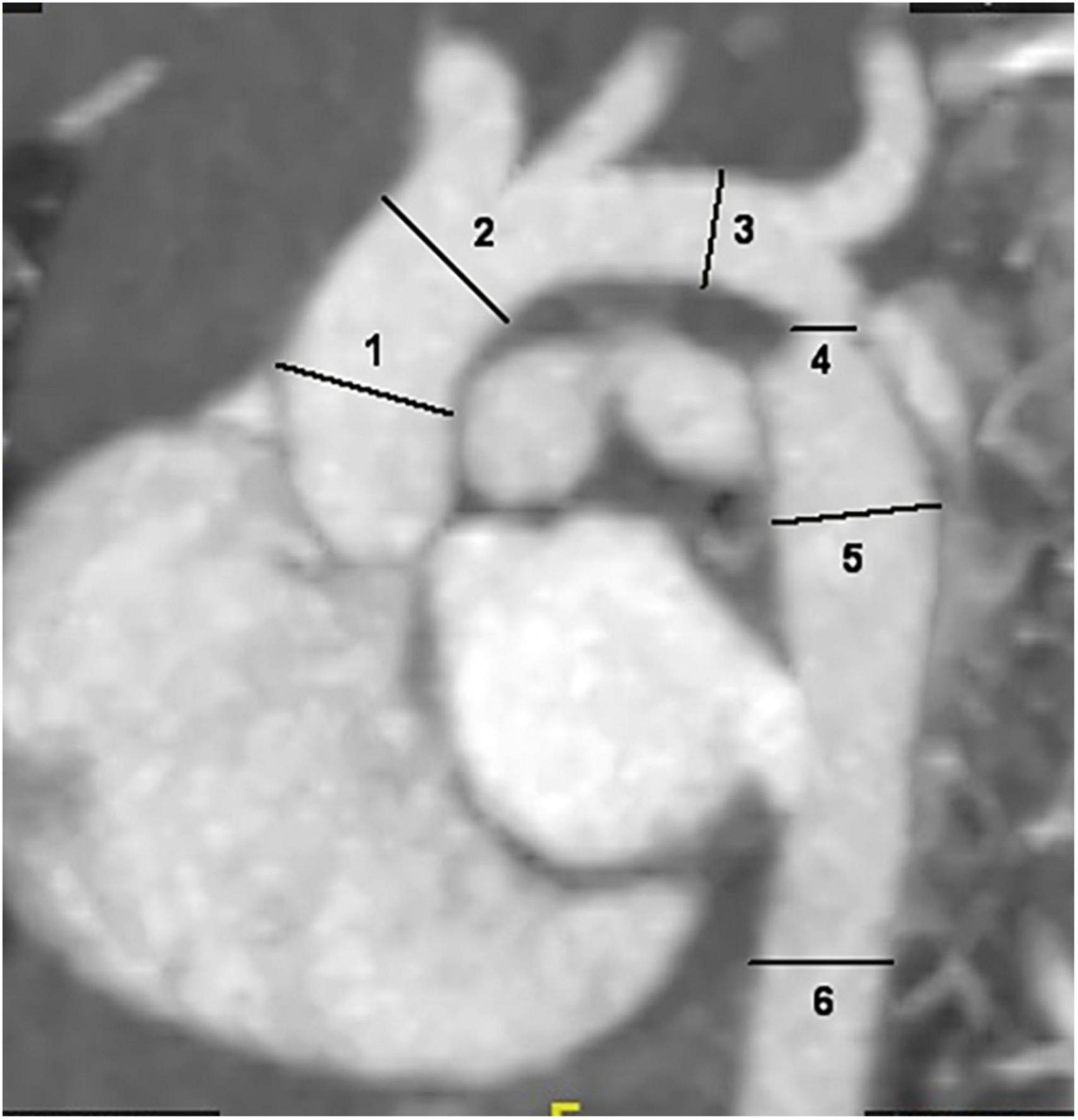 Evaluation of the aorta in infants with simple or complex coarctation of the aorta using CT angiography